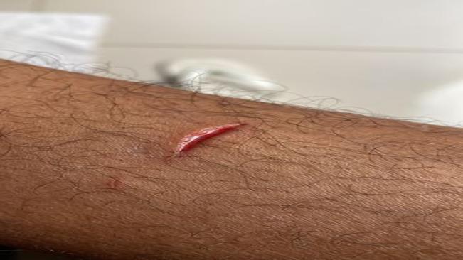 Descarte de material cortante deve ser embalado adequadamente